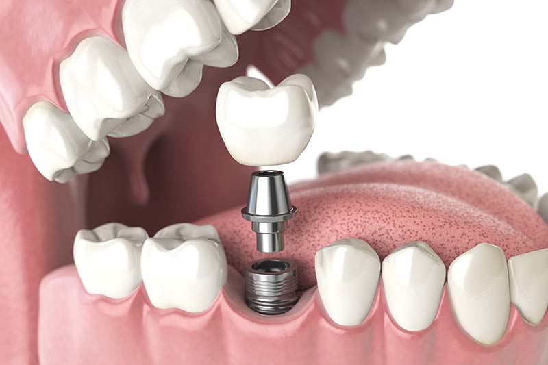 植牙合併骨脊重建